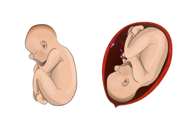 Descolamento prematuro de placenta: saiba mais sobre o assunto